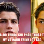 Ronaldo Trước Khi Phẫu Thuật Thẩm Mỹ Và Hành Trình Lột Xác